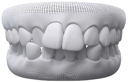 Dientes Apiñados